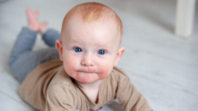 حساسية الطعام عند الأطفال: الأسباب، الأعراض، العلاج