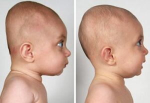 متلازمة الرأس المسطح عند الرضع